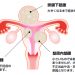 葉酸は子宮筋腫の予防と改善効果