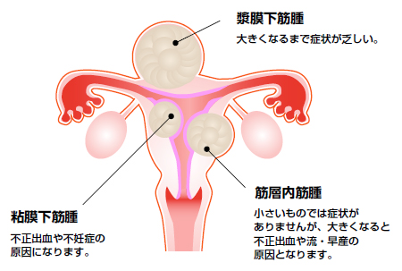 葉酸は子宮筋腫の予防と改善効果